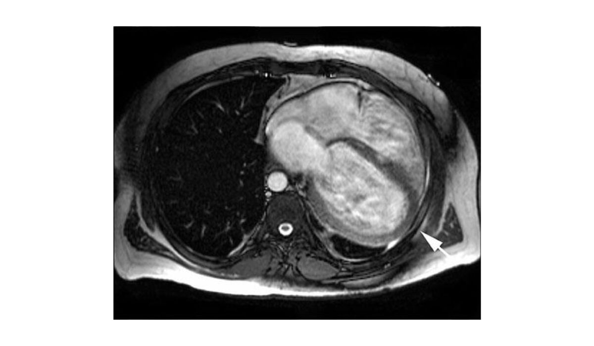 Congenital absence of anterior pericardium at left ventricular assist device implantation