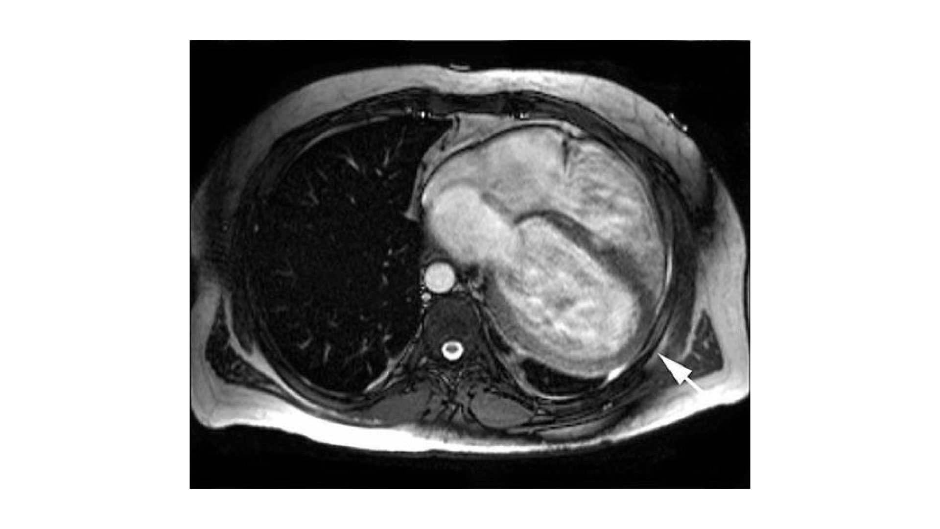 Congenital absence of anterior pericardium at left ventricular assist device implantation