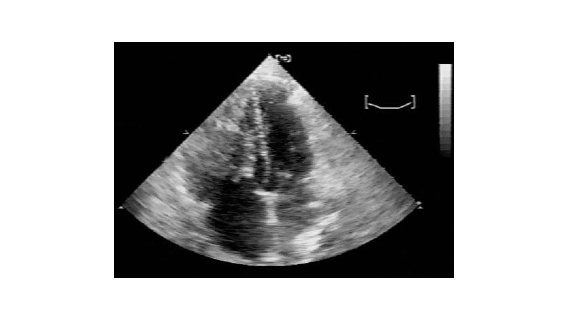 Sarcoma metastatic to the right ventricle-surgical intervention followed by prolonged survival