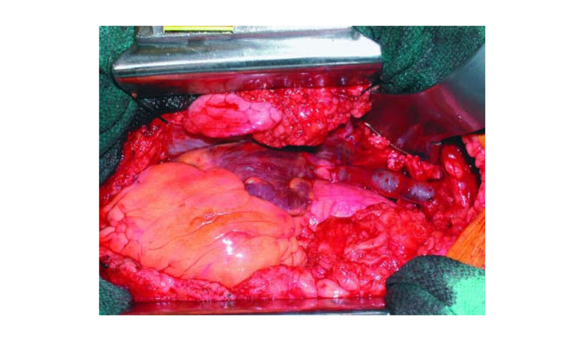 Superior vena caval bypass using the superficial femoral vein for treatment of superior vena cava syndrome