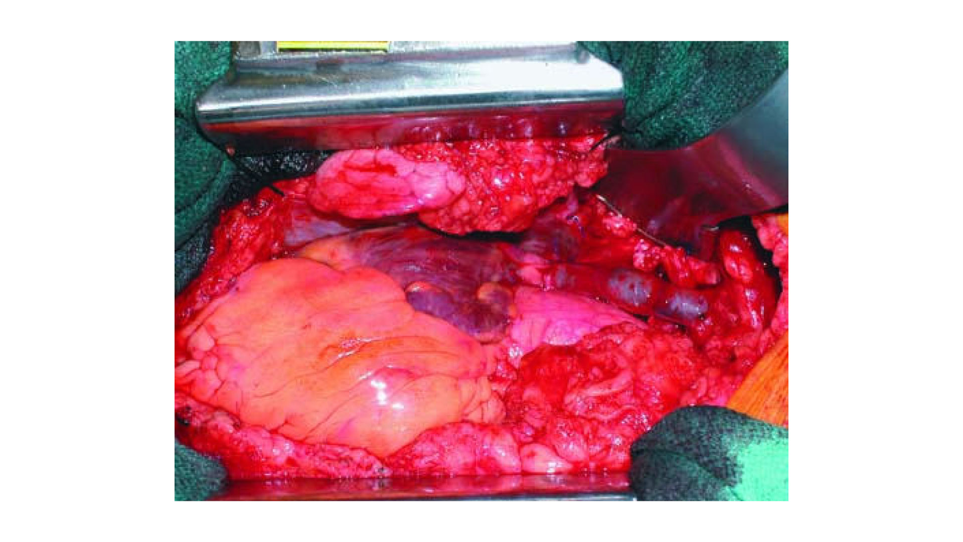 Superior vena caval bypass using the superficial femoral vein for treatment of superior vena cava syndrome