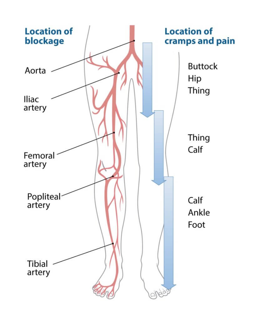 The leg highlighting and labeling major arteries, including the femoral, popliteal, and tibial arteries.