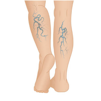 VARICOSE VEINS