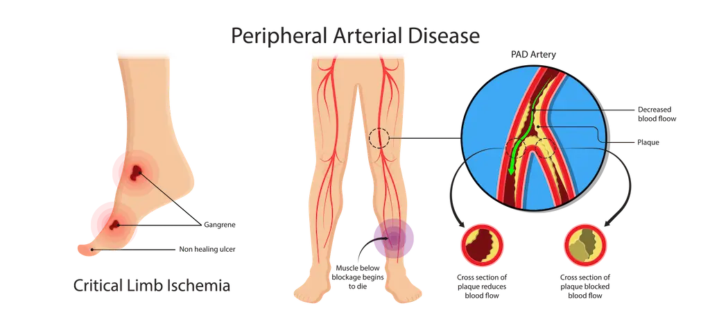 Leg showing narrowed arteries with reduced blood flow, a key characteristic of peripheral artery disease (PAD). The image highlights the buildup of plaque inside the arteries, leading to restricted circulation and potential symptoms like pain and cramping.