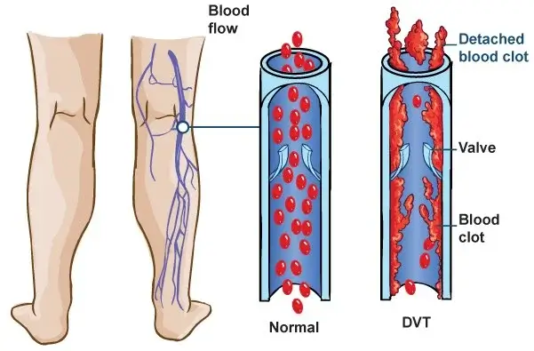 Ilustración médica que muestra un coágulo de sangre en una vena profunda de la pierna, característico de la trombosis venosa profunda (DVT). El coágulo bloquea el flujo sanguíneo normal, causando dolor, hinchazón y posibles complicaciones graves.