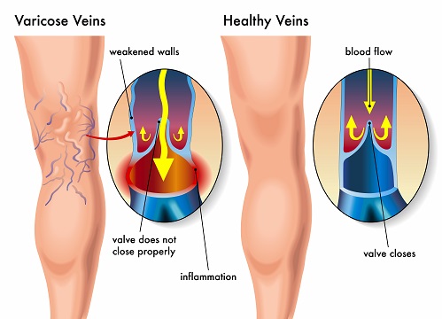 The difference between normal veins and varicose veins: Normal veins have smooth walls and functioning valves that ensure proper blood flow, while varicose veins are enlarged, twisted, with damaged valves, leading to blood pooling and visible swelling.